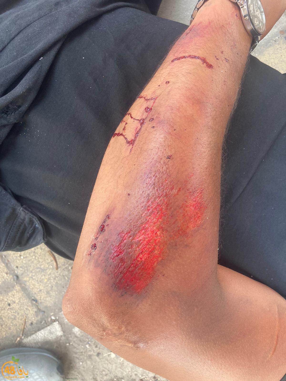  يافا: اصابة متوسطة لراكب دراجة نارية بحادث طرق ذاتي