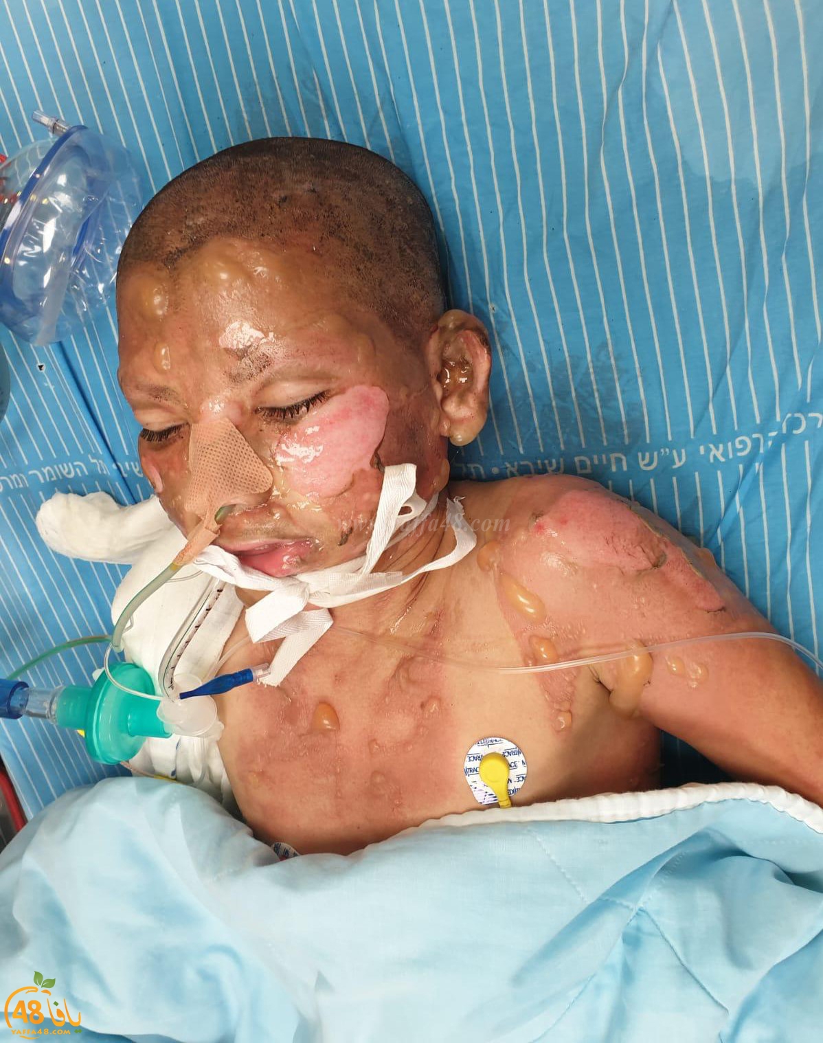 يافا: تدهوّر حالة أحد الأطفال المصابين بجريمة احراق البيت بالعجمي