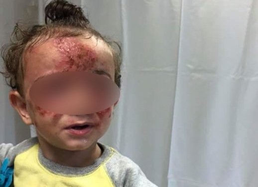 والد من كفركنا: طفلي تعرض لحروق خطيرة في جسمه خلال تواجده في الحضانة
