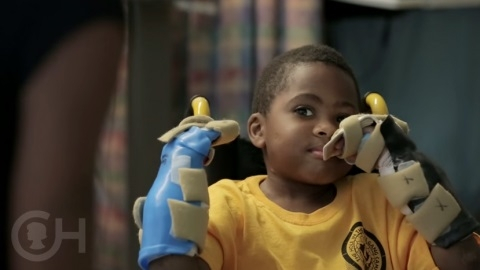 فيديو: نجاح أول عملية زراعة يدين لطفل بالعالم