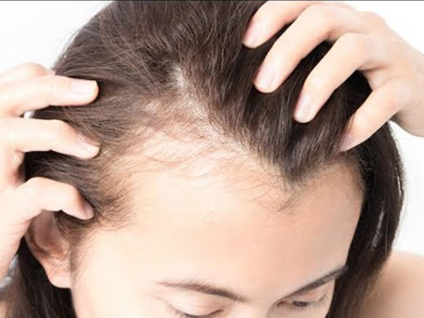  جهاز "رخيص الثمن" للقضاء على الصلع