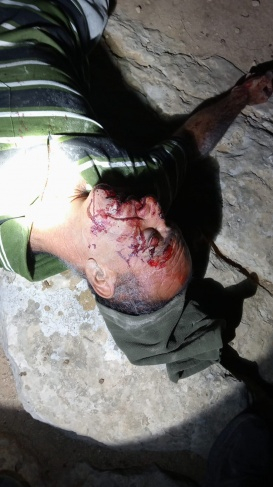 المستوطنون يواصلون ارهابهم: اعتداء دموي يخلف إصابات شرق يطا