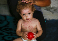 أوبئة جلدية "غربية" تضرب مخيمات النازحين في غزة