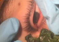 بالفيديو: طبيبة تخرج دودة من عين صبي