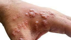 جدري القردة: إصابة في إسرائيل وحالات أخرى حول العالم