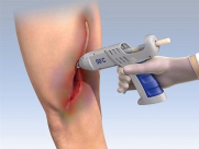 ابتكار جديد- صمغ طبي يلحم الجروح الخطيرة