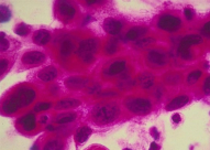  لقاح جديد ضد سرطان الجلد