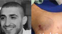 الرملة: إصابة خطرة لشاب اثر تعرضه للدغة أفعى في كفرقاسم