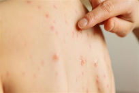 وباء الحصبة يغزو العالم