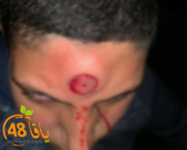 احذروا المفرقعات - فتى من الرملة يُصاب في وجهه اثر العبث بالألعاب النارية 