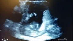 فيديو: جنين "يصفق" داخل رحم أمه