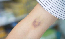 تستيقظ فتجد كدمة على جسدك؟ الأسباب أكثر خطورة مما تتوقع