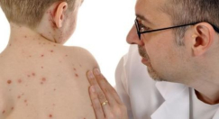 تشخيص 3 حالات جديدة بعدوى الحصبة