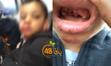 يافا: اصابة طفل بحادث دهس "ضرب وهرب" ووالده يُطالب السائق بالتواصل معها