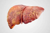 اختراق جديد.. علماء أميركيون يكتشفون عقاراً لتليف الكبد