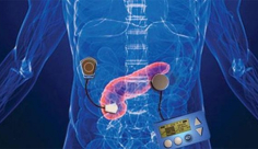 أول بنكرياس اصطناعي بالعالم يصل للأسواق في 2017