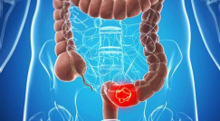 انخفاض  نسبة وفيات سرطان الأمعاء الغليظة في المجتمع اليهودي مقارنة بالمجتمع العربي