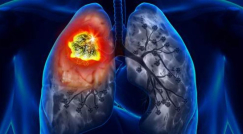 إدارة الغذاء والدواء الأمريكية توافق على علاج جديد لمرضى سرطان الرئة