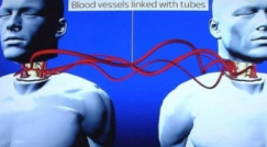 إجراء أول عملية "ناجحة" لزراعة رأس جثة بشرية