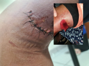 فيديو: طفل يافاوي ما زال يُعاني اثر اصابته برصاصة مطاطية قبل أكثر من شهر