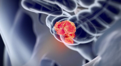 يموت بسببه يومياً نحو 3 نساء ورجال، تعرف على سرطان القولون